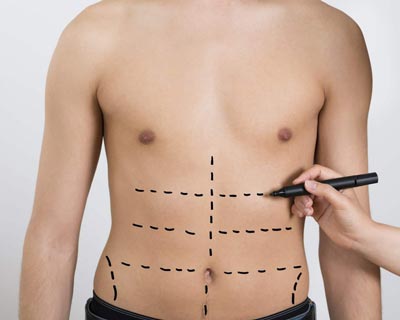 جراحی لیپوماتیک - لیپوماتیک چیست؟
